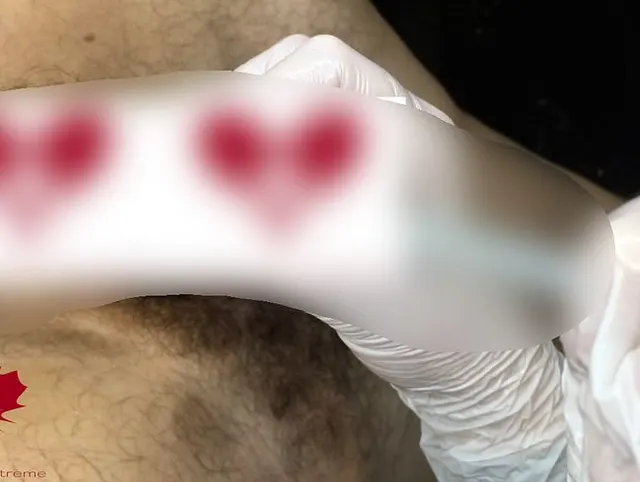 Sperm extraction with a glass drinking straw. A different way of urethral sounding. Alternativ.