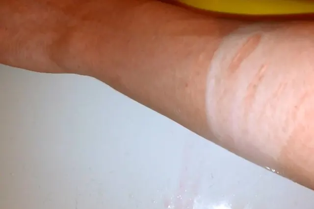 emo fetisch milch auf narben