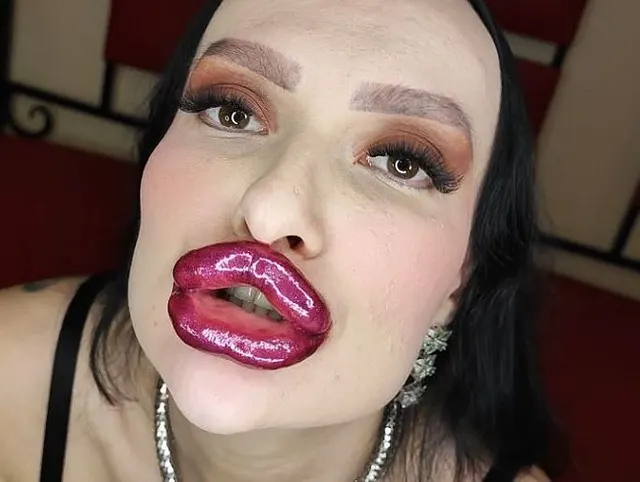 Lippenkorrektur bei großem Schwanz unmittelbar nach der Lippenvergrößerung