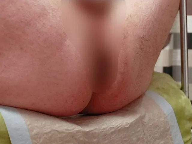 Anales Fisting: Junger Student Marcus Pollack wird von Krankenschwester auf dem Gynstuhl gedehnt