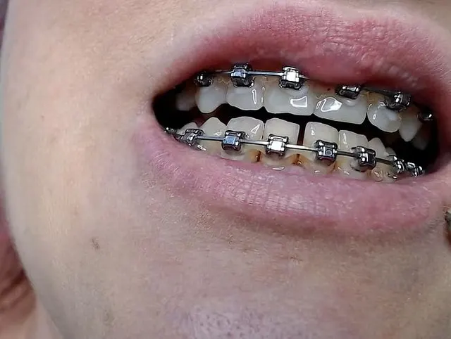 Zahnspange und Zungenpiercing Nahaufnahme