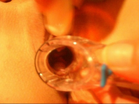 speculum und vibroei